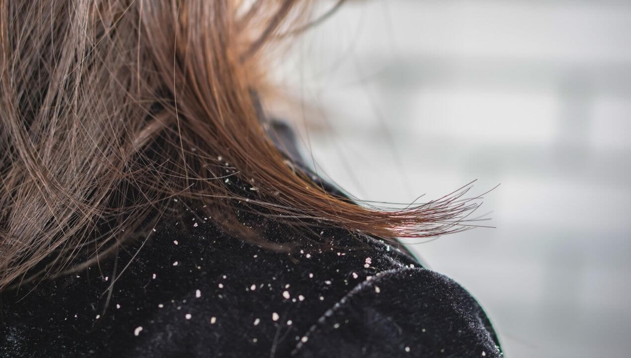 Dandruff / Seborrhoeic Dermatitis