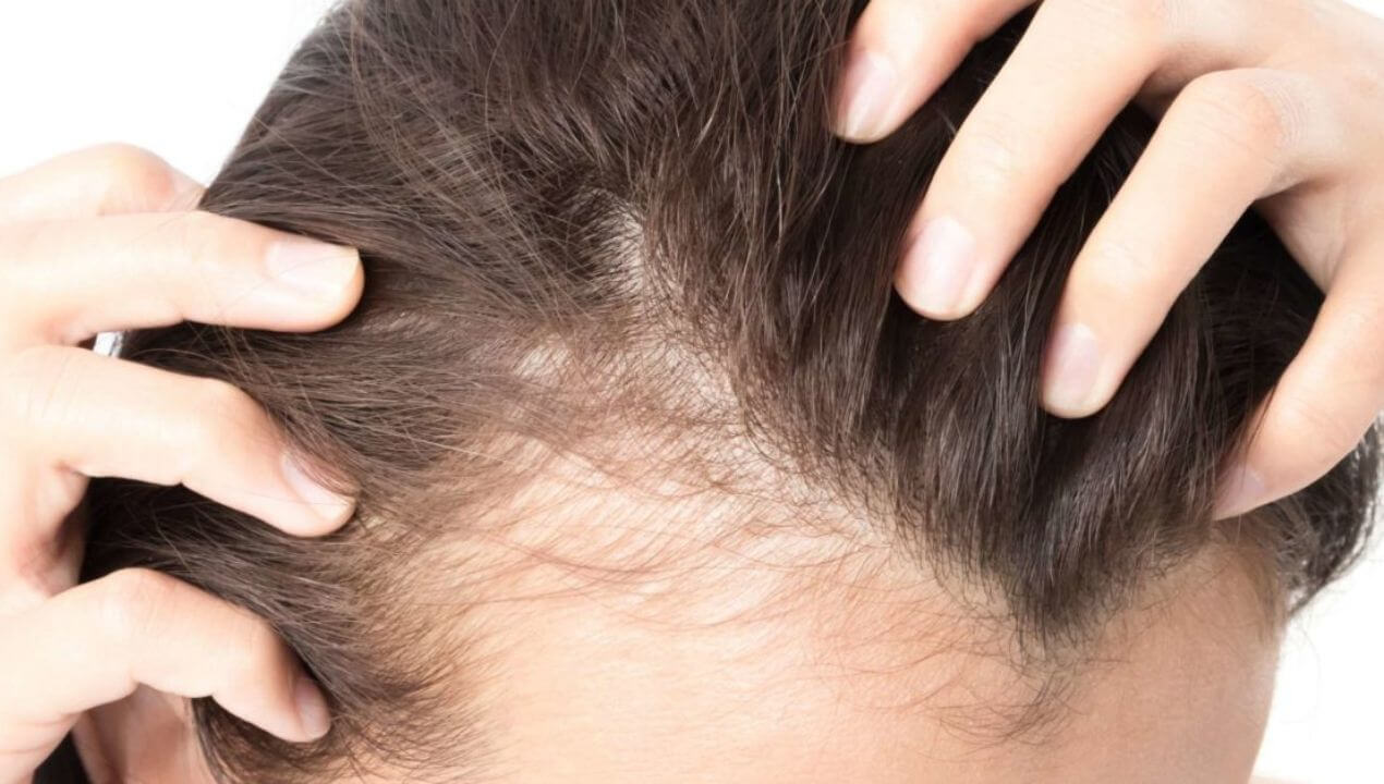 Female pattern hair loss (Baldness)