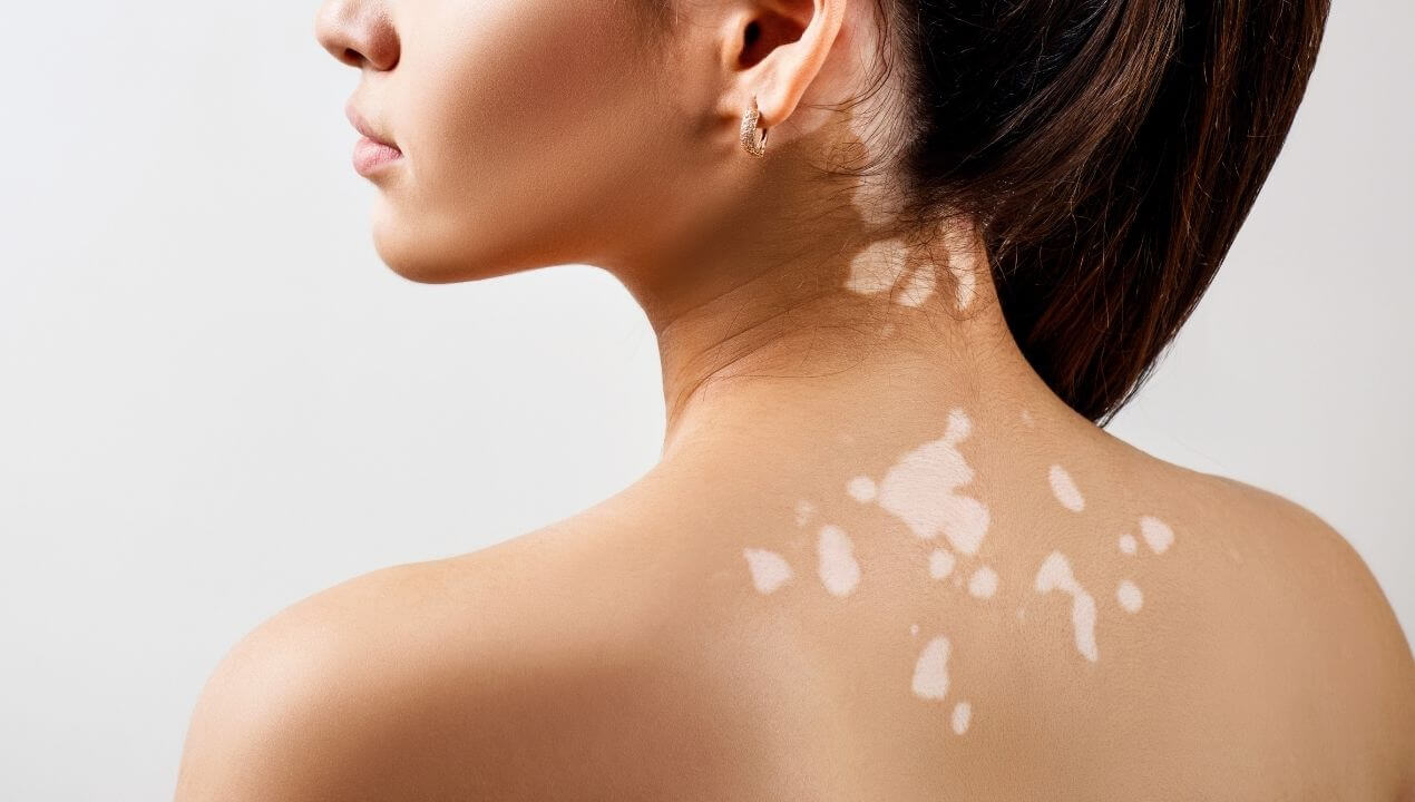 Back skin affected by vitiligo