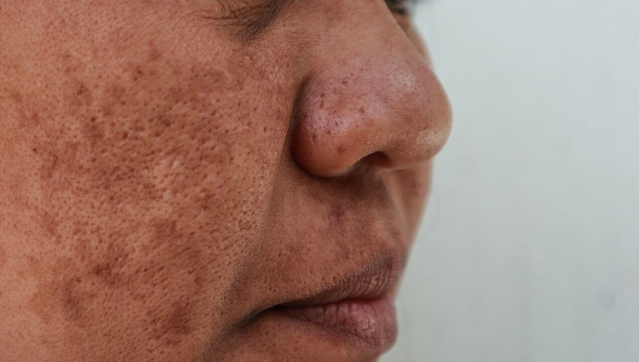 Cheeks skin is affected by melasma or pigmentation