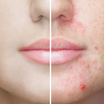 Woman Face Before After Acne Treatment