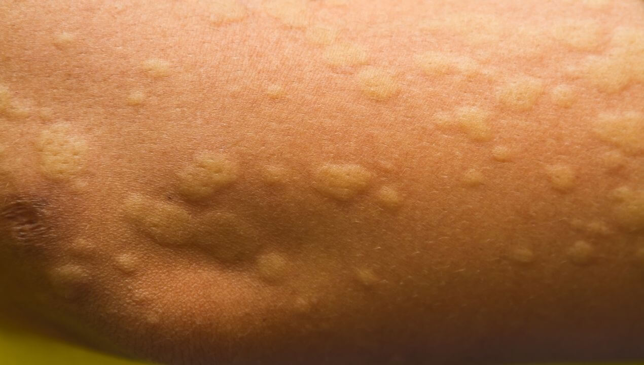 Urticaria Skin Reaction